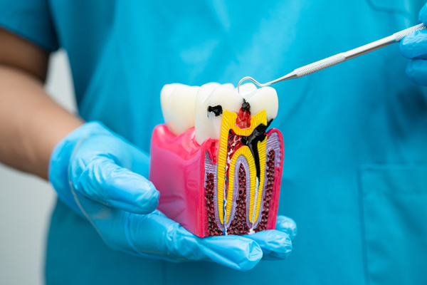 Signs You May Need A Root Canal: When To See A Dentist